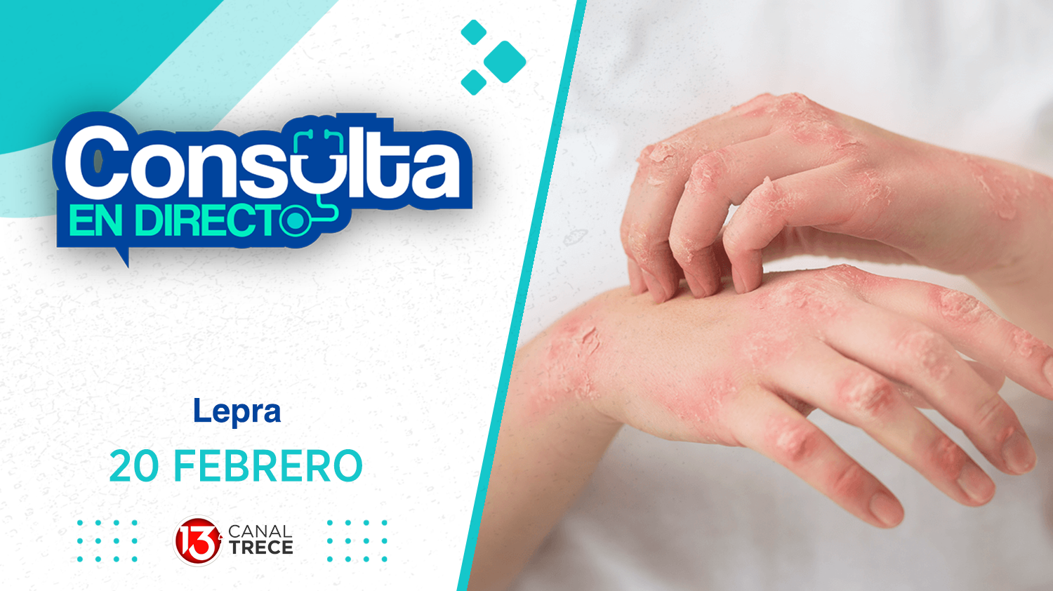 Lepra - Consulta en Directo | 20 Febrero 2025 