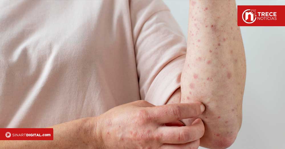 Salud pide revisar vacuna contra el sarampión si viajará al Mundial 2026