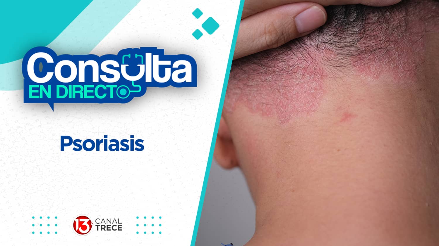 Psoriasis | Consulta en directo 26 abril 2024. Programa Completo.